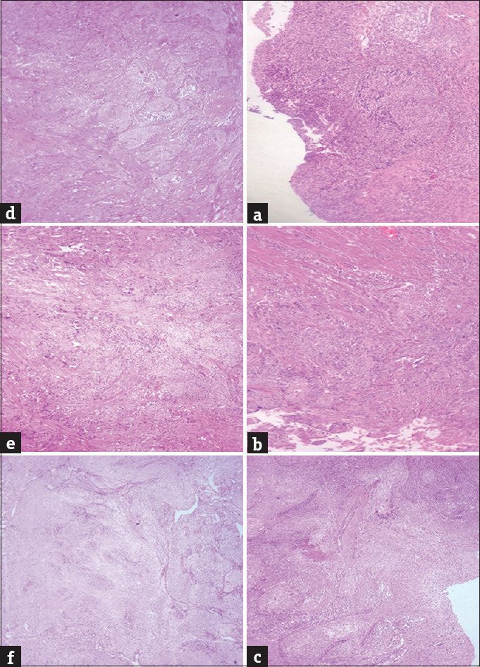 Unusual Extension of Superficial Spreading Squamous Cell Carcinoma of Cervix to Uterus, Paraovarian, Paratubal Tissue, and Vaginal Surface: A Unique Case Report.
