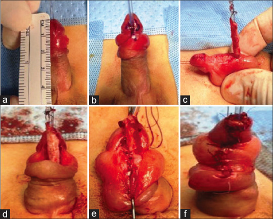 Retrospective Comparative Study between Duplay and Koff Methods in Repair of Distal Hypospadias.