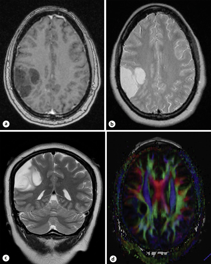 Status Epilepticus and Low-Grade Glioma in the Pregnant State: Case Report and Ethical Considerations.