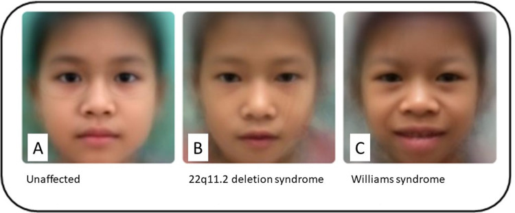 Comparison of the Accuracy in Provisional Diagnosis of 22q11.2 Deletion and Williams Syndromes by Facial Photos in Thai Population Between De-Identified Facial Program and Clinicians.