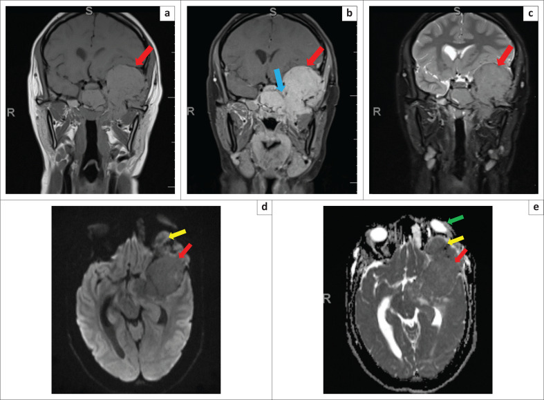 Multiple myeloma in a young female presenting as an aggressive skull-base tumour.
