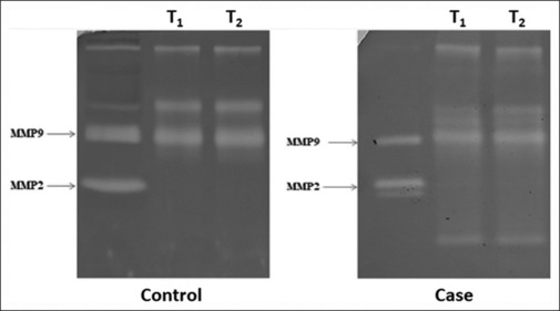Investigating salivary matrix metalloproteinase-2 and matrix metalloproteinase-9 activity in fixed orthodontic-induced gingival enlargement.