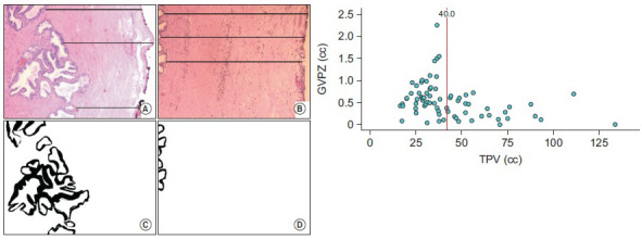 Computerized metric assessment of glandular tissue volume within the peripheral zone of the prostate using combined magnetic resonance imaging and histopathology: Possible pathophysiological implications on prostate cancer development.