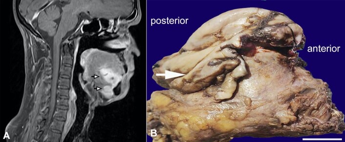 Submandibular and sublingual salivary gland involvement in adenoid cystic carcinoma.