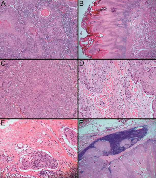 Epidemiological and Histopathological Features of Oral Squamous Cell Carcinoma-A Retrospective Study.