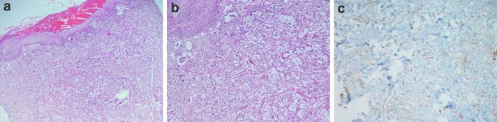 Cutaneous Metastases of Signet-Ring Cell Gastric Carcinoma: A Case Report.