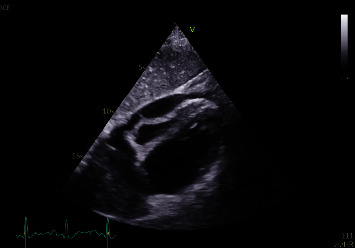 Hodgkin Lymphoma Presenting as Cardiac Tamponade in a Young Female.