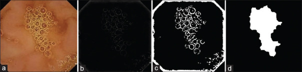 Identification of Circular Patterns in Capsule Endoscopy Bubble Frames.