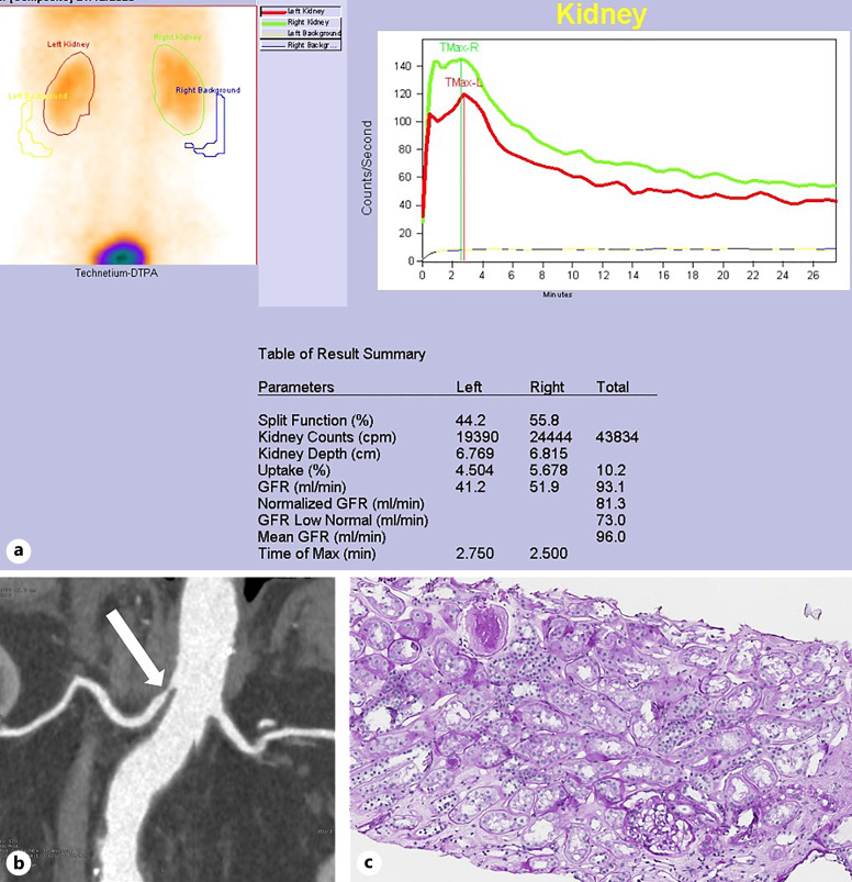 Individualized Decision-Making and Outcomes for the 87-Year-Old Living Kidney Donor: A Case Report.