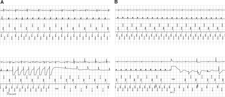 Utility of an Externalized Temporary Transvenous Implantable Cardioverter-defibrillator System in the Setting of Ventricular Tachycardia Storm and Concurrent Device Infection Requiring Extraction.