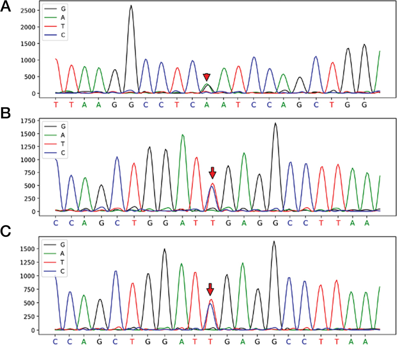 Recurrent Cerebral Venous Sinus Thrombosis Occurred in an Acute Lymphoblastic Leukemia Child with Mutated Lipoprotein Lipase Gene during Asparaginase Therapy.