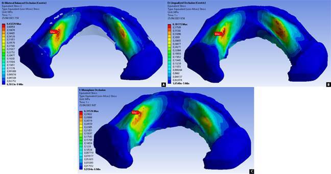 Pain-related analysis on a resorbed ridge with various denture occlusal schemes using finite element method.