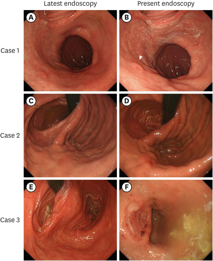 Characteristics of Metachronous Remnant Gastric Cancer After Proximal Gastrectomy: A Retrospective Analysis.