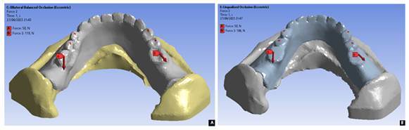 Pain-related analysis on a resorbed ridge with various denture occlusal schemes using finite element method.