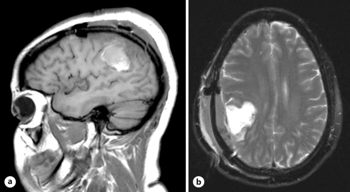 Status Epilepticus and Low-Grade Glioma in the Pregnant State: Case Report and Ethical Considerations.