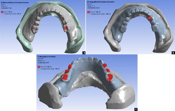 Pain-related analysis on a resorbed ridge with various denture occlusal schemes using finite element method.