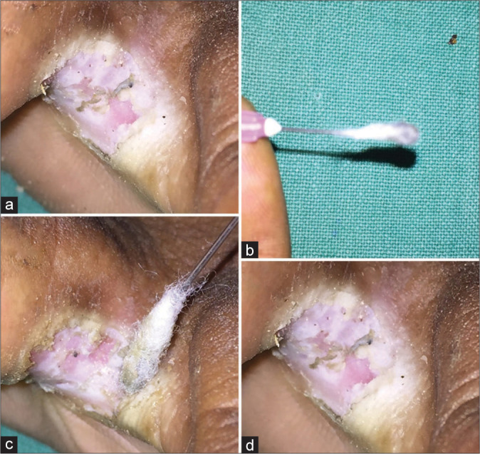 Therapeutic pearl: A simple cost-effective treatment for chronic digital intertrigo of toes.