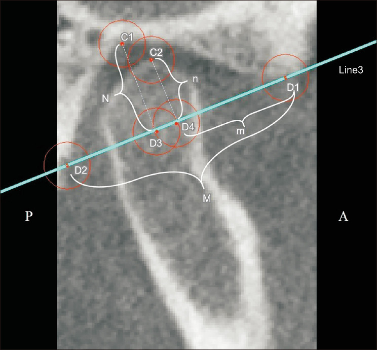 Evaluation of mandibular condyle position in Class III patients after bimaxillary orthognathic surgery: A cone-beam computed tomography study.