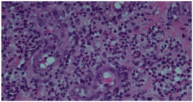 Idiopathic Granulomatous Mastitis, Erythema Nodosum, and Polyarthritis.