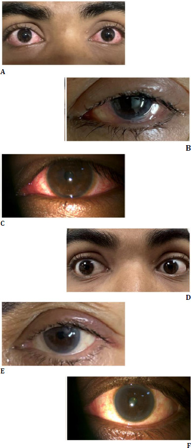 One-time low concentration betadine eye wash: A novel treatment for epidemic viral conjunctivitis for accelerated recovery.
