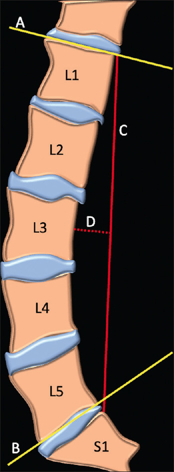 Lumbar offset distance: A simplified metric for evaluation of the lumbar spine alignment.