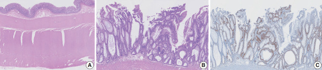 Tubular adenoma arising in tubular colonic duplication: a case report.