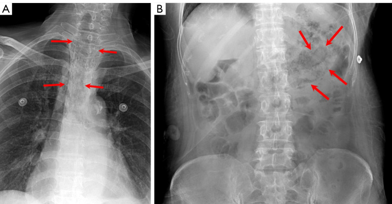 Conservative management of emphysematous esophagitis-a case report.