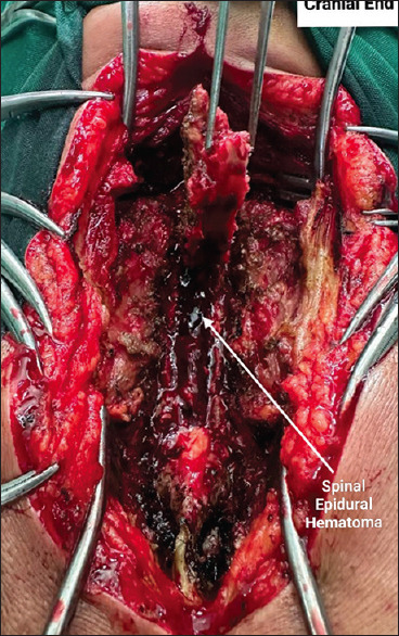 Catastrophic spontaneous spinal epidural hematoma following thrombolysis: An intersection of neurosurgical and cardiological challenges - An institutional experience.