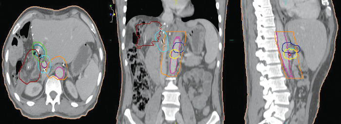 Perihilar and Intrahepatic Cholangiocarcinoma after Resection: Clinicopathological Characteristics, Outcomes, and Implications for Addition of Chemoradiotherapy.