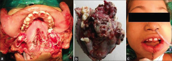 Aggressive Osteosarcoma of the Mandible in a 13-Year-Old Girl.