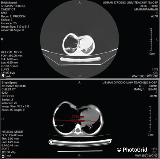 Single-stage Open Lobectomy and Modified Ravitch Procedure in an Infant with Coexisting Severe Pectus Excavatum and Congenital Cystic Adenomatous Malformation.