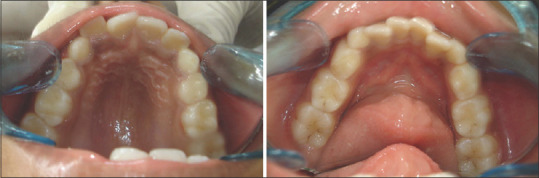 Assessment of Factors Associated with Mandibular Anterior Crowding in Mixed Dentition.