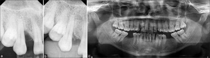 Treatment of periodontal infrabony defect using particulate dentin graft and recombinant human platelet-derived growth factor.