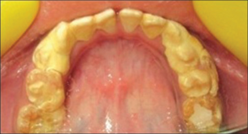 Comparative evaluation of oral hygiene status by using oral hygiene index, simplified oral hygiene index, and modified oral hygiene index: Revalidation of modified oral hygiene index.