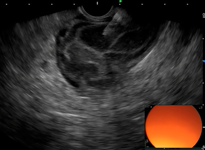 A rare but interesting case of small intestinal tumor diagnosed by transrectal EUS-FNA (with video).