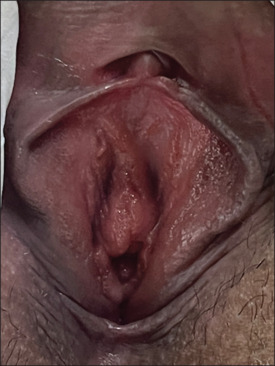 Micropapillomatosis labialis - Report of three cases.