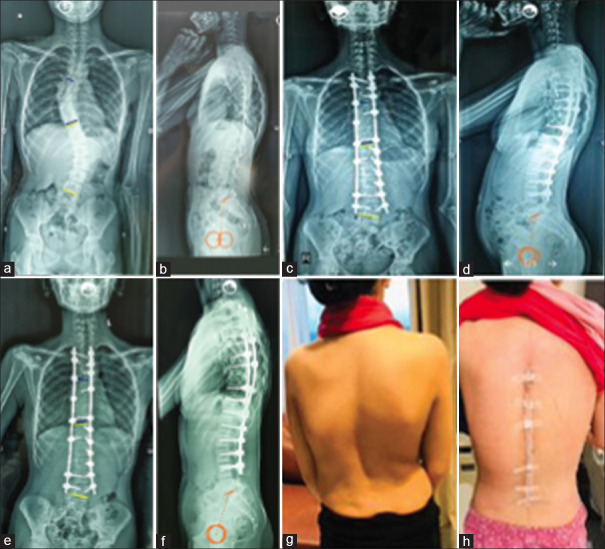 Do low-density screws influence pelvic incidence in adolescent idiopathic scoliosis correction?