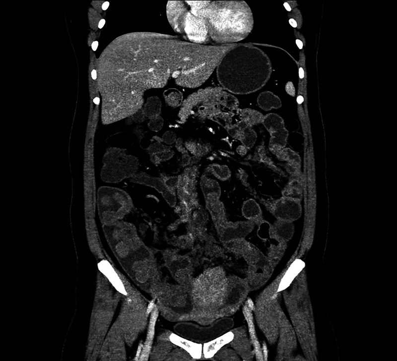 A rare but interesting case of small intestinal tumor diagnosed by transrectal EUS-FNA (with video).