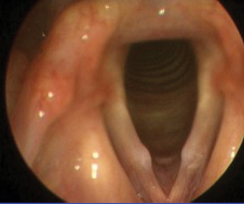Accuracy of Diagnosis of Benign Vocal Fold Lesions among Ear, Nose, and Throat Residents.