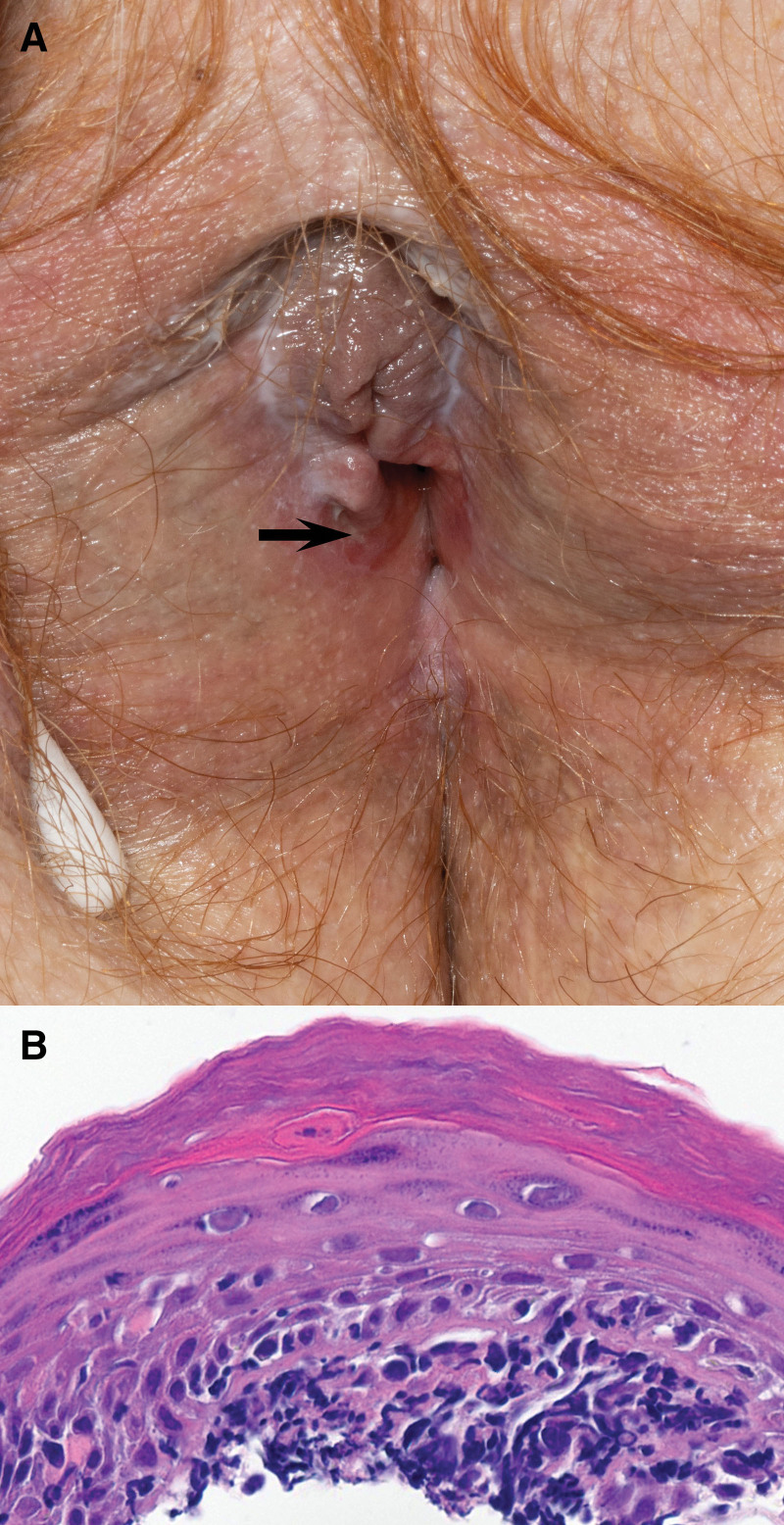 Lichenoid tissue eruption of the vulva associated with immune checkpoint inhibitor.