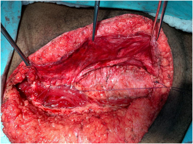 INTRA-ABDOMINAL PRESSURE MONITORING DURING LÁZARO DA SILVA'S PROCEDURE FOR VENTRAL HERNIA REPAIR: A CROSS-SECTIONAL STUDY.