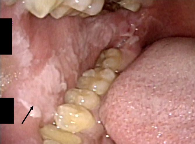 <i>Alocasia odora</i> poisoning due to calcium oxalate needle crystals in Japan.