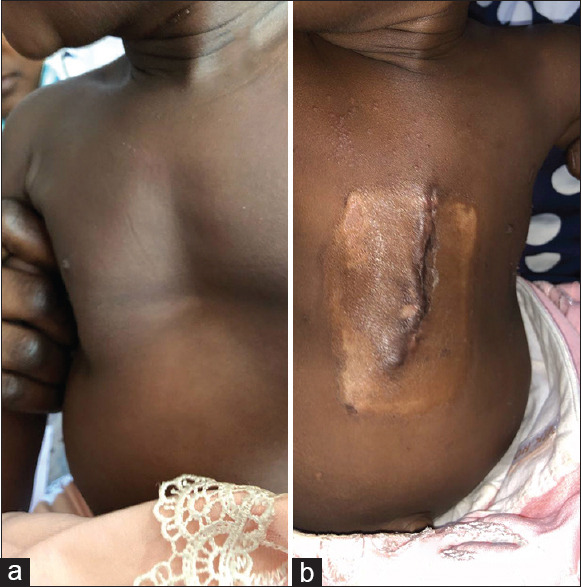 Single-stage Open Lobectomy and Modified Ravitch Procedure in an Infant with Coexisting Severe Pectus Excavatum and Congenital Cystic Adenomatous Malformation.