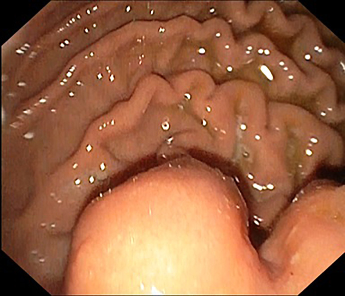 Tuberculosis of the Stomach Mimicking Gastric Submucosal Tumor: Diagnosis by Endoscopic Ultrasound.