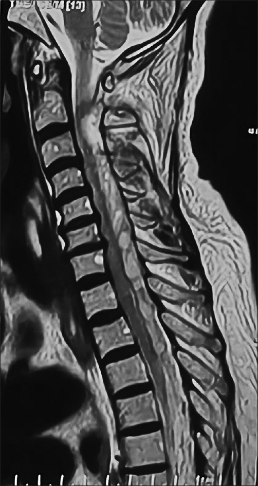 Catastrophic spontaneous spinal epidural hematoma following thrombolysis: An intersection of neurosurgical and cardiological challenges - An institutional experience.