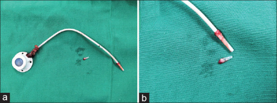 Difficult Removal of a Stuck Chemoport Catheter of a Paediatric Patient in Post-Coronavirus Disease (COVID-19) Era - Management Strategies and Literature Review.