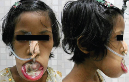 Aggressive Osteosarcoma of the Mandible in a 13-Year-Old Girl.