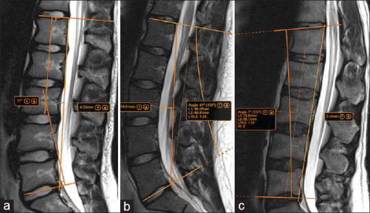Lumbar offset distance: A simplified metric for evaluation of the lumbar spine alignment.