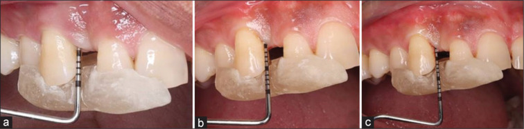 Treatment of periodontal infrabony defect using particulate dentin graft and recombinant human platelet-derived growth factor.