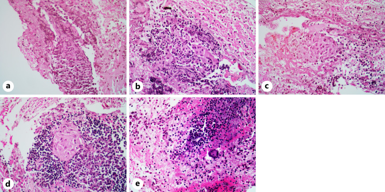 Tuberculosis of the Stomach Mimicking Gastric Submucosal Tumor: Diagnosis by Endoscopic Ultrasound.